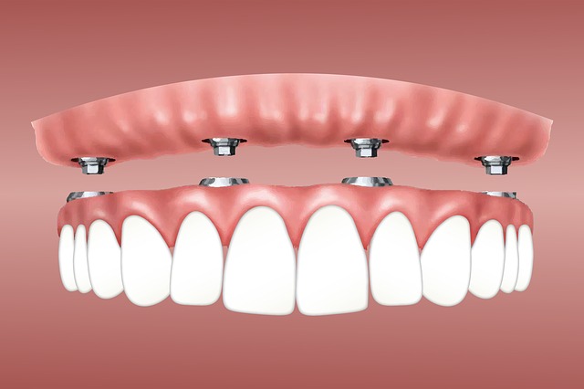Cosa rende gli impianti dentali estremamente confortevoli e sicuri